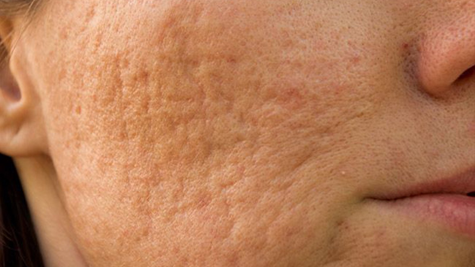 Acne Scar Program