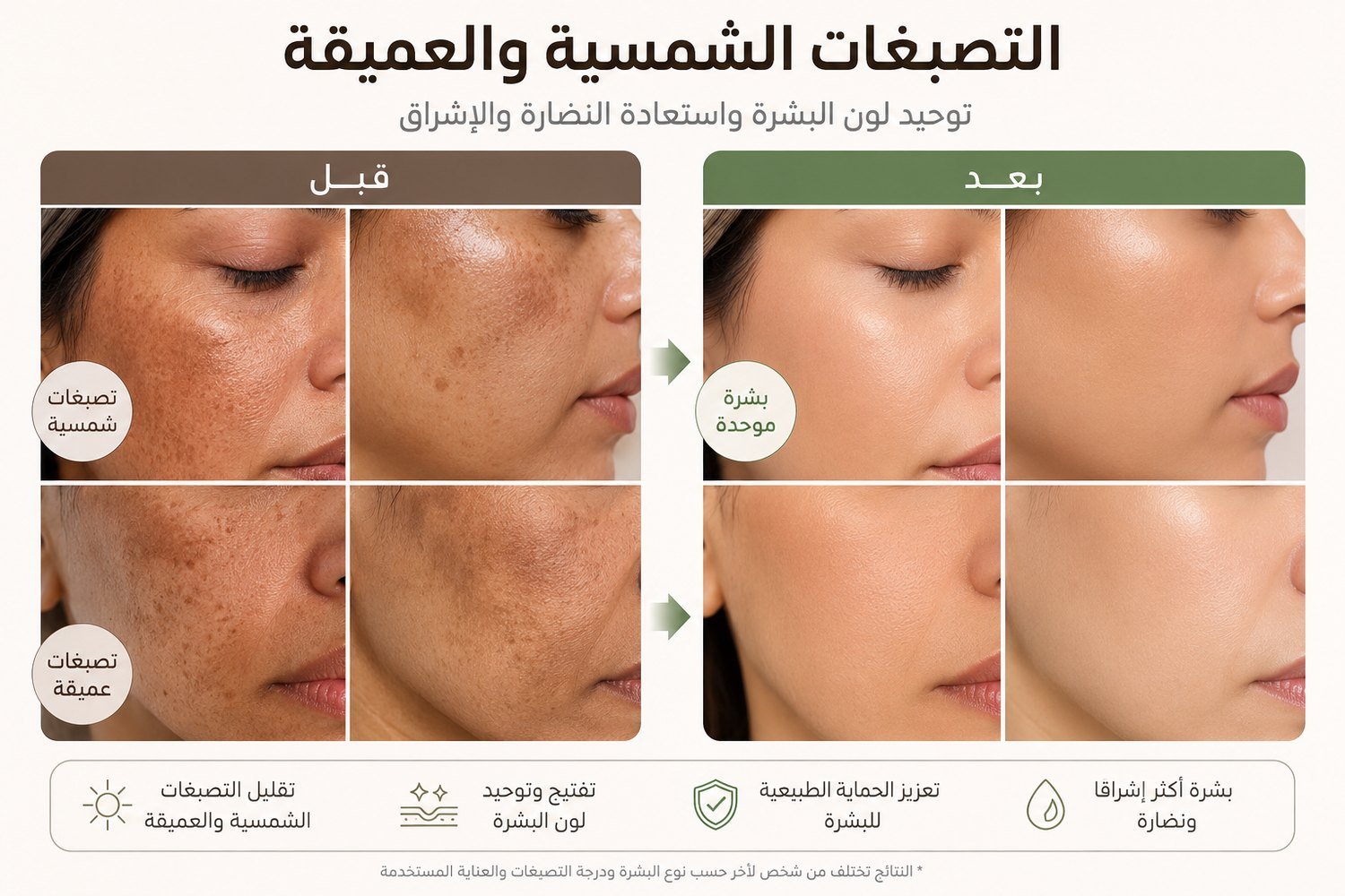 Melasma Program